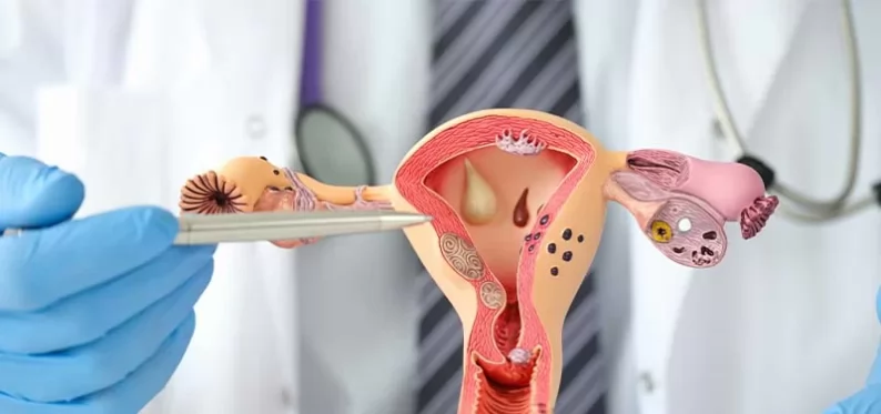 Yumurtalık Kisti Tedavisi: Kapsamlı Rehber ve Güncel Yaklaşımlar