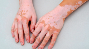 Nişantaşı’nda Excimer Lazer ile Vitiligo Tedavisi