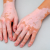 Nişantaşı’nda Excimer Lazer ile Vitiligo Tedavisi